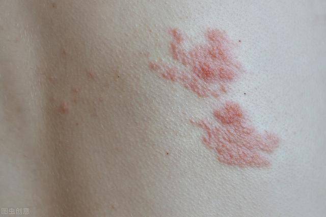 缠腰龙疱疹应该怎么治吃什么药，缠腰带疱疹用什么药