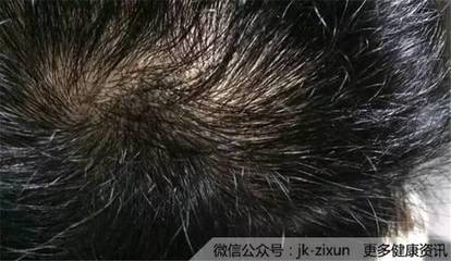 头皮类型自测：油性、干性、敏感性与脂溢性皮炎