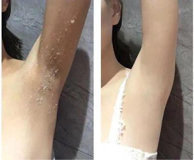 身体护理升级：去角质、保湿与改善“鸡皮肤”