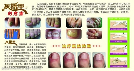 灰指甲激光治疗管用吗，灰指甲激光治疗多少钱